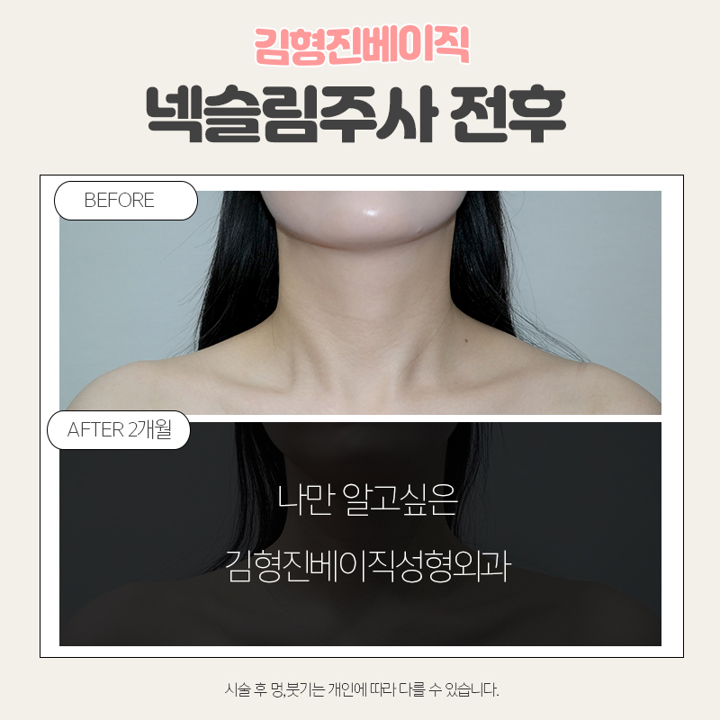 웨딩시술은 김형진베이직에서! 관련 이미지 7