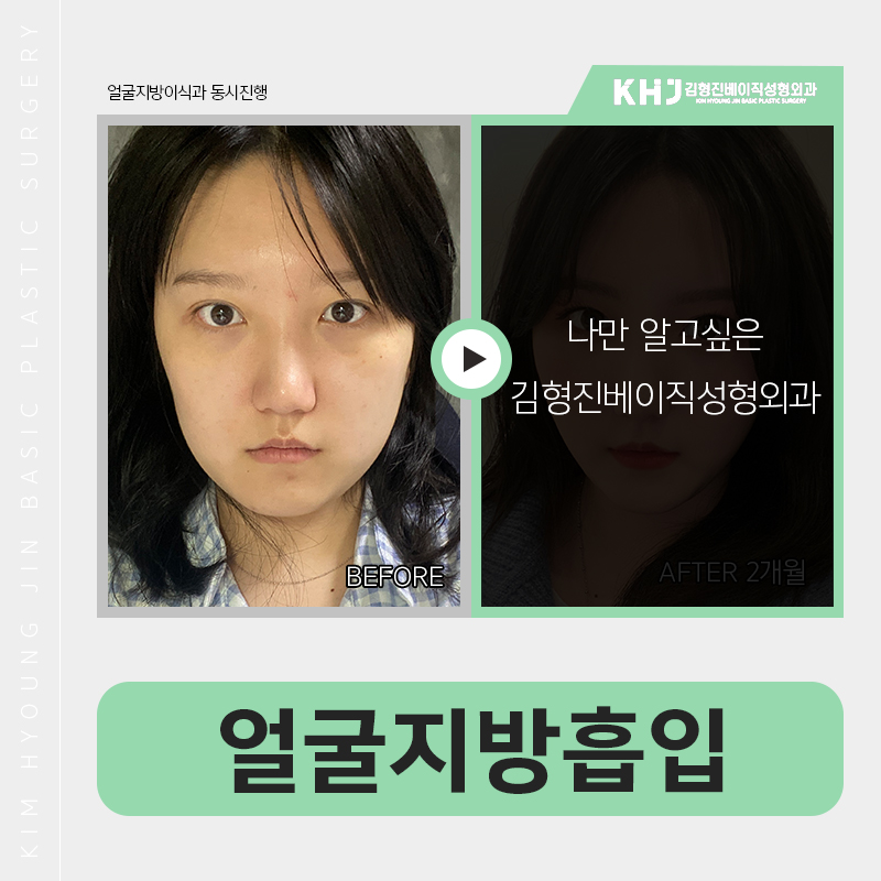얼굴지방흡입방법 어떻게 진행되냐구요? 관련 이미지 5