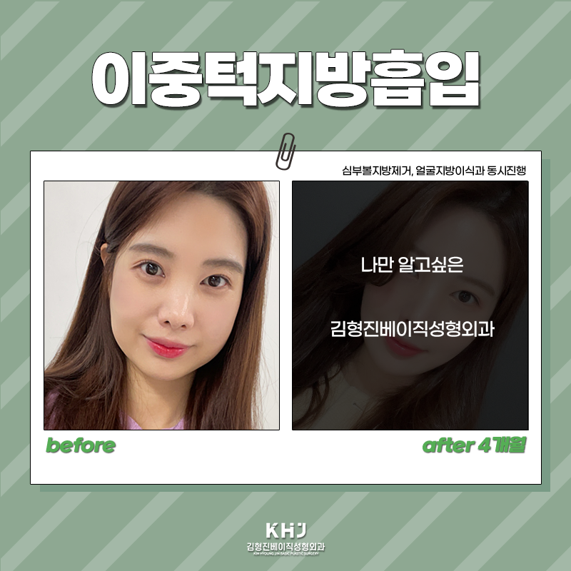 압구정이중턱지방흡입 어디가 좋을까 고민중이시라면? 관련 이미지 5