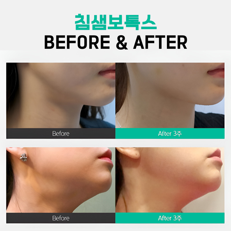Apgujeong Salivary Gland Botox If Your Jawline Looks Blunt image 6