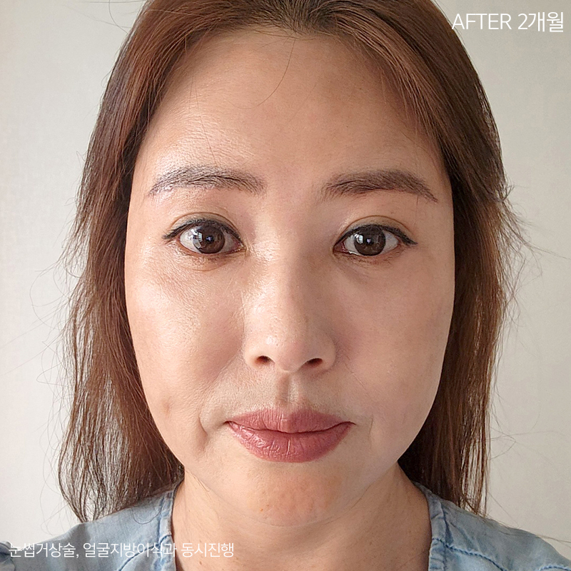 중년눈밑지방 고민은 김형진베이직에서 해결! 관련 이미지 4