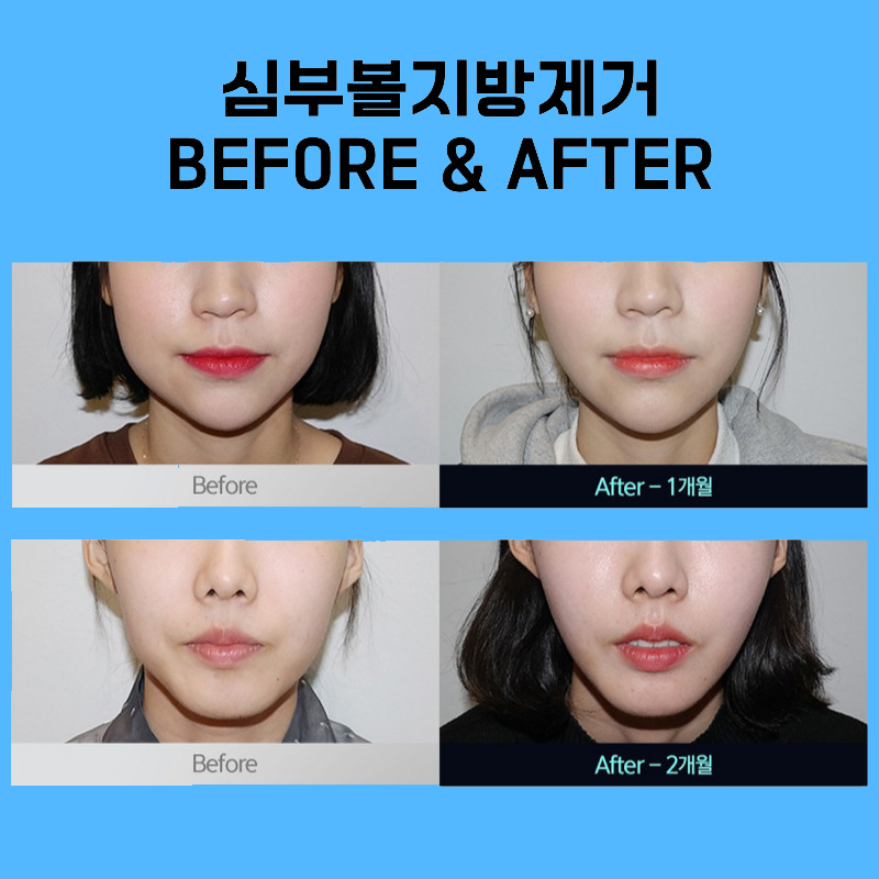 울퉁불퉁 얼굴형, 심부볼지방제거수술 받으면 어떻게 될까? 관련 이미지 6