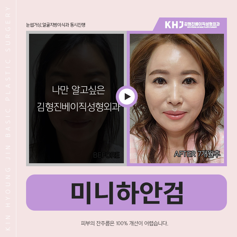 미니하안검흉터 걱정하지마세요! 관련 이미지 6