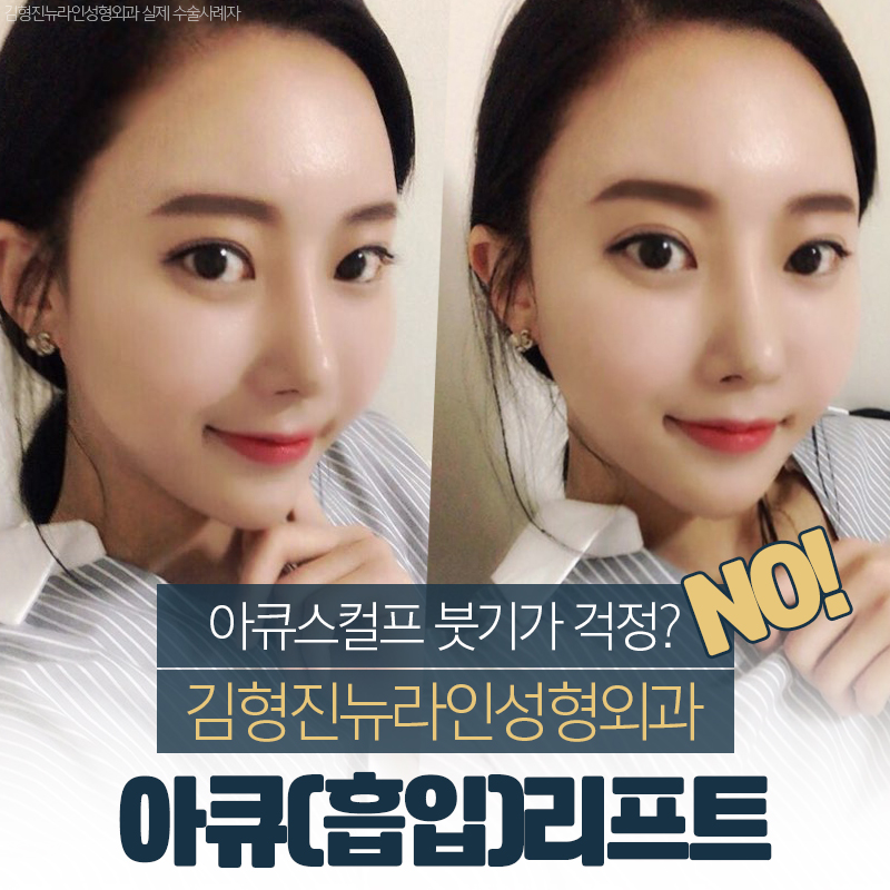 아큐스컬프붓기 급이 다른 이유 관련 이미지 1