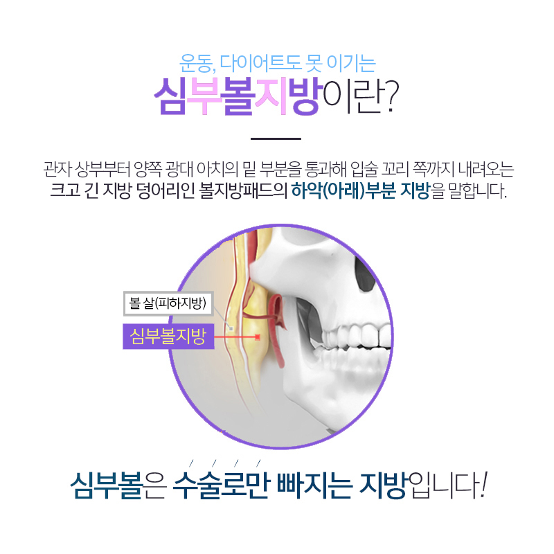 볼살제거방법으로 이 방법 선택한 합리적인 이유 관련 이미지 4