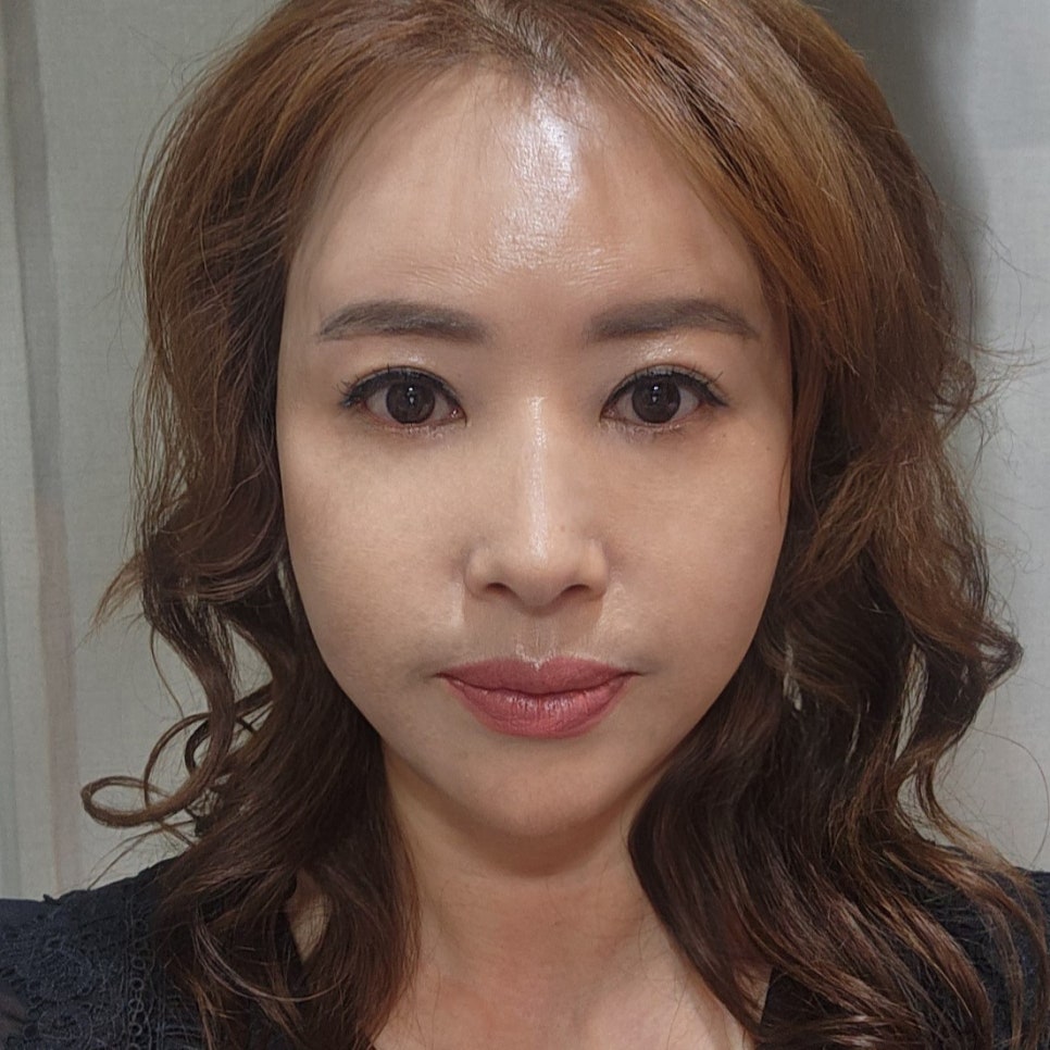 중년수술, 미니하안검후기 보고 결정하세요! 관련 이미지 1