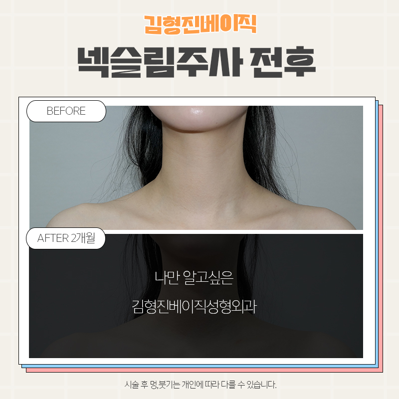 목보톡스후기 김형진베이직만 한 곳 없죠 관련 이미지 6