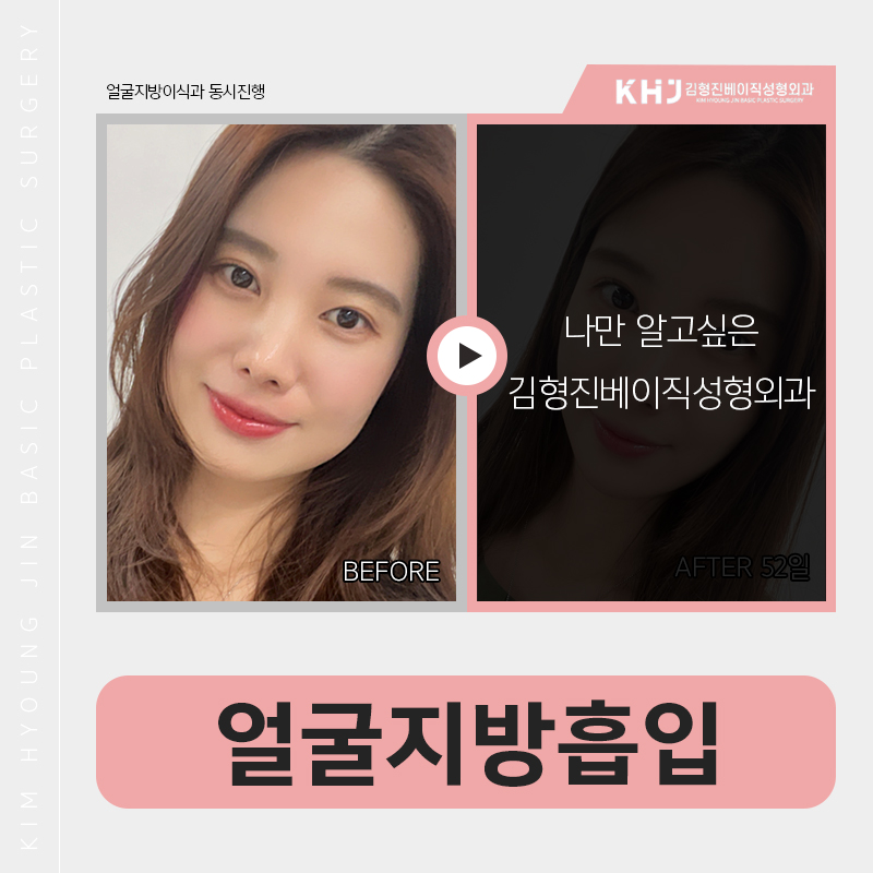 얼굴지방흡입처짐 걱정하시고계세요? 관련 이미지 3