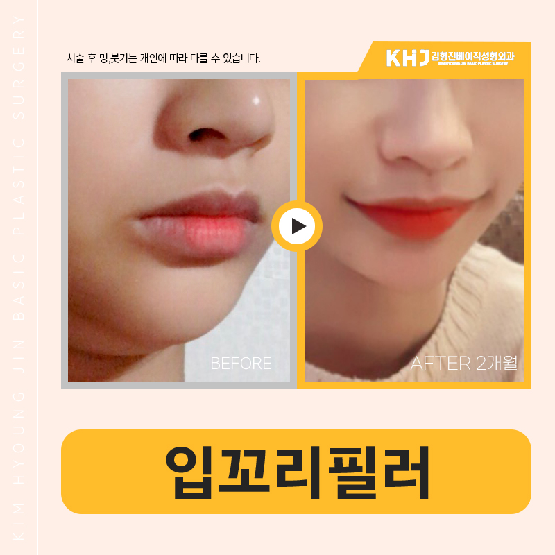 후기 많은 입꼬리필러추천이 필요하다면 여기에요! 관련 이미지 5