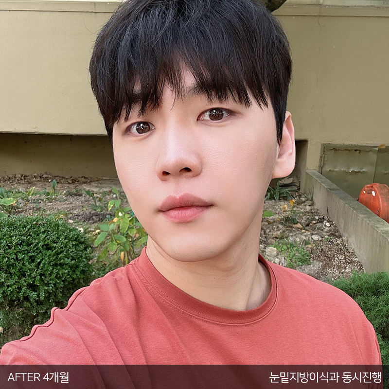 눈밑지방재배치수술효과 모르시는분! 관련 이미지 6