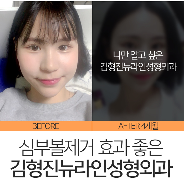 심부볼효과 확실하니까 관련 이미지 3