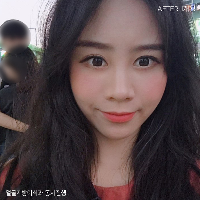 눈밑지방재배치회복과정이 빠를 수밖에 없는 이유 관련 이미지 5