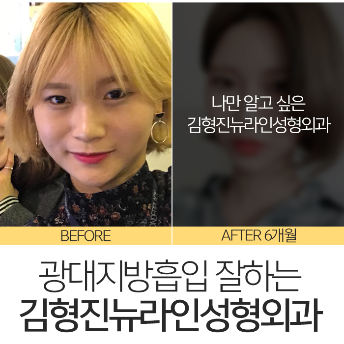 광대지방흡입 김형진뉴라인성형외과지 관련 이미지 3