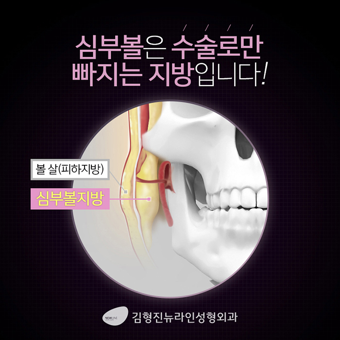 심술보리프팅 김형진뉴라인에서는? 관련 이미지 3