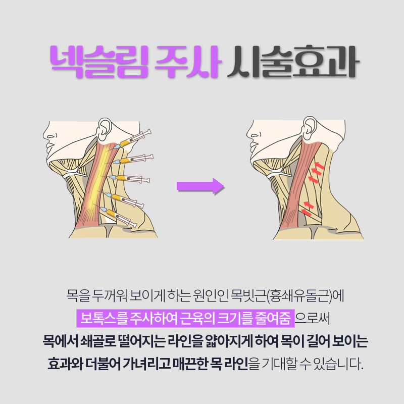 압구정웨딩관리 목 라인과 승모근 라인 한방에 정리하는 방법 관련 이미지 4