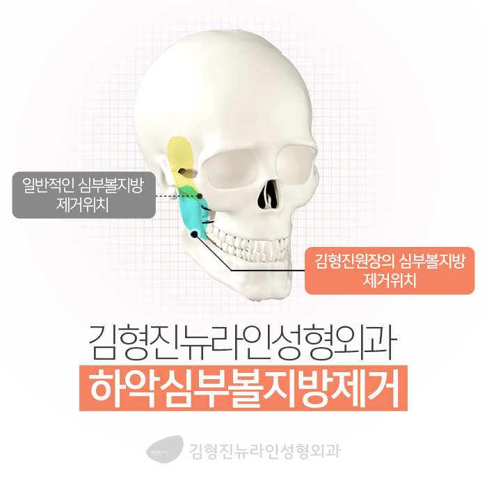 심부볼패임 어떻게 하느냐에 따라 달라요 관련 이미지 5