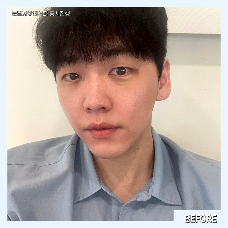 눈밑지방재배치변화과정 한눈에 확인하고 가세요! 관련 이미지 3