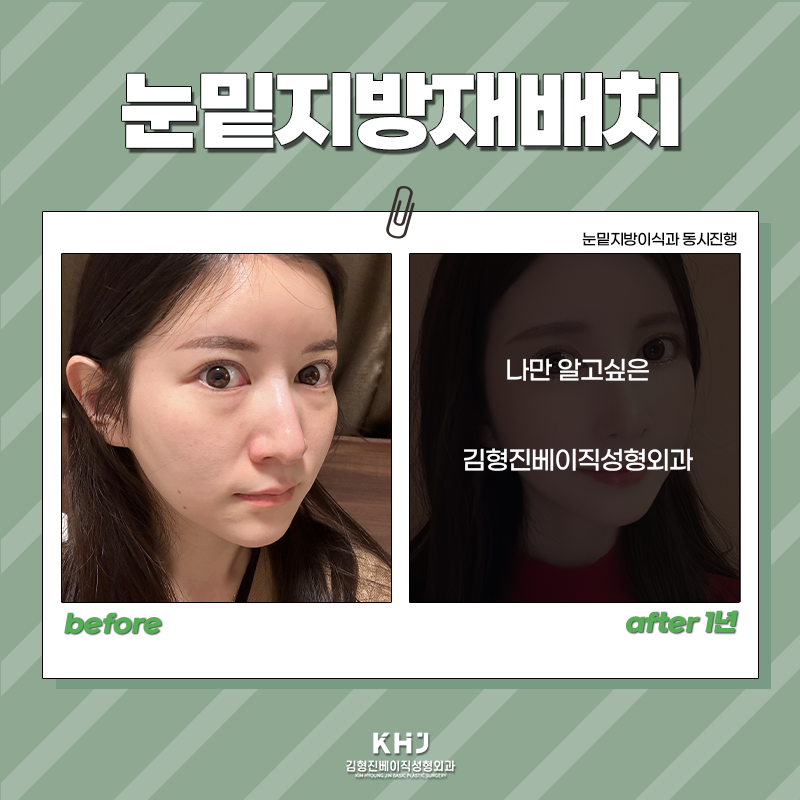 눈밑지방재배치재발? 김형진베이직에서는 걱정없어요 관련 이미지 5