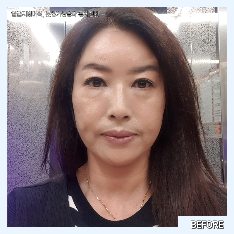 미니하안검흉터 김형진베이직에서는 걱정 없어요! 관련 이미지 3