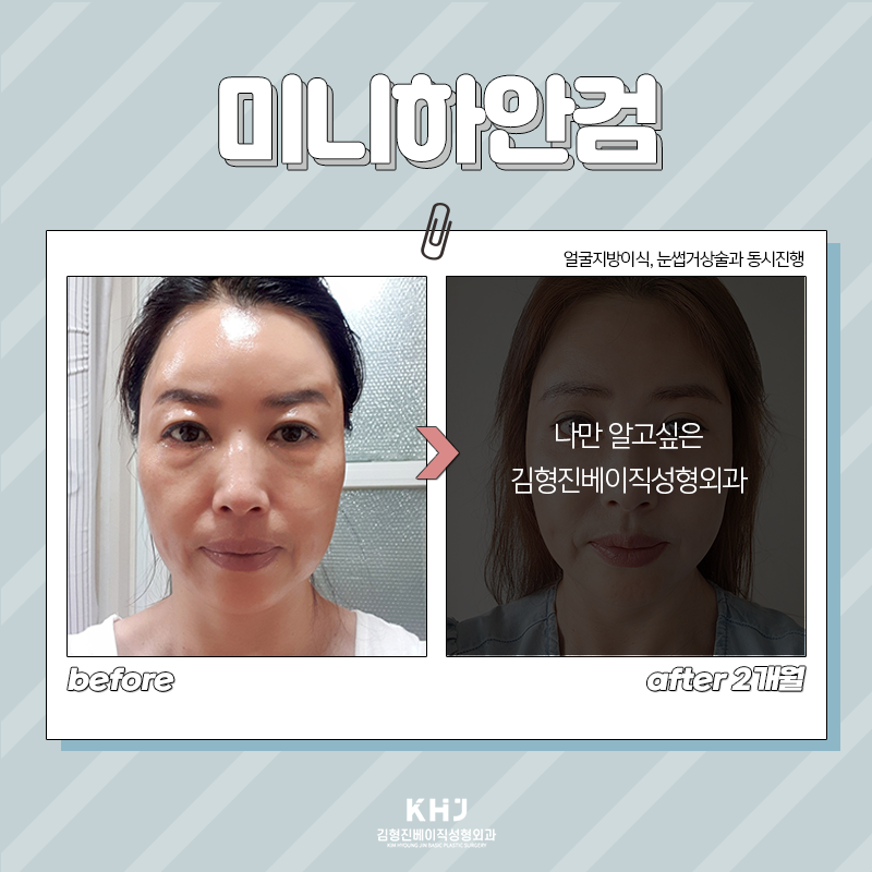 미니하안검수술 어떤 효과가 있냐면요 관련 이미지 4