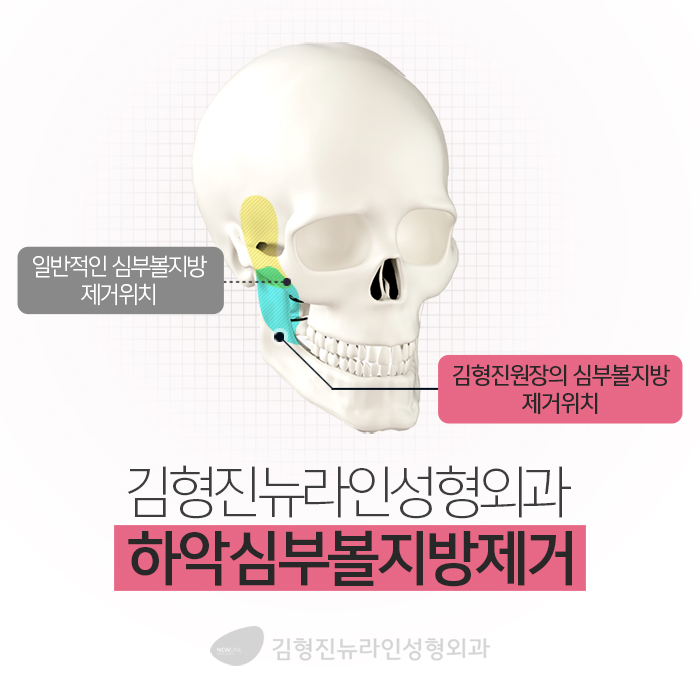 심부볼당일수술 그리고 만족한 결과! 관련 이미지 3