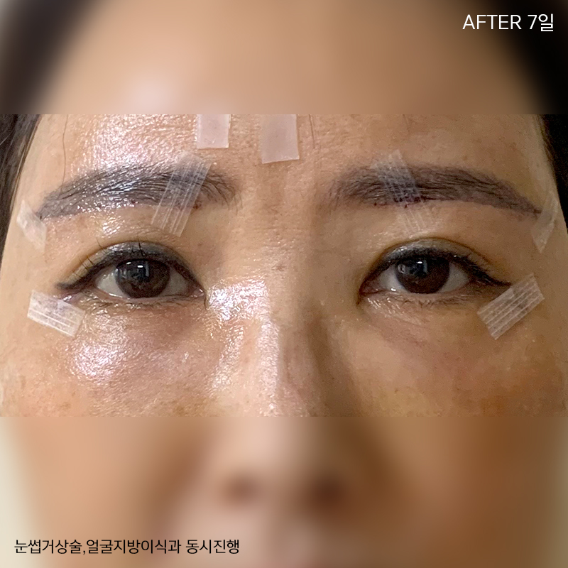 미니하안검회복과정 한 눈에 확인! 관련 이미지 4