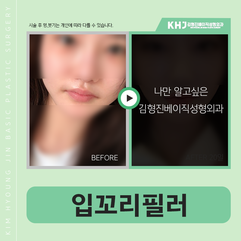입꼬리필러효과 아직도 모르셨다면 클릭! 관련 이미지 5