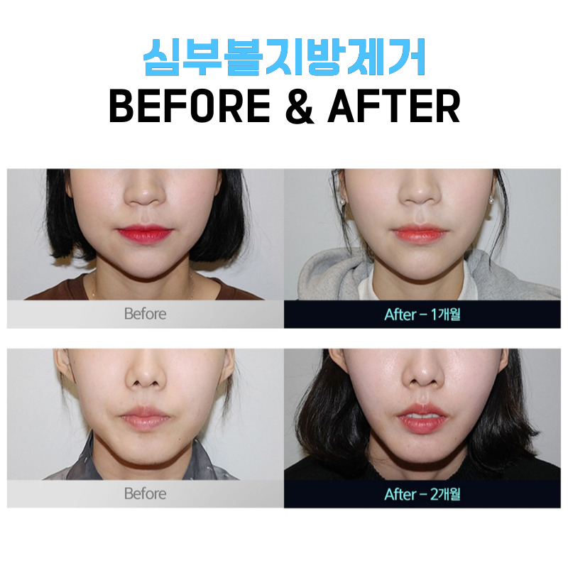 심부볼제거전후 볼패임 걱정 없이! 관련 이미지 5