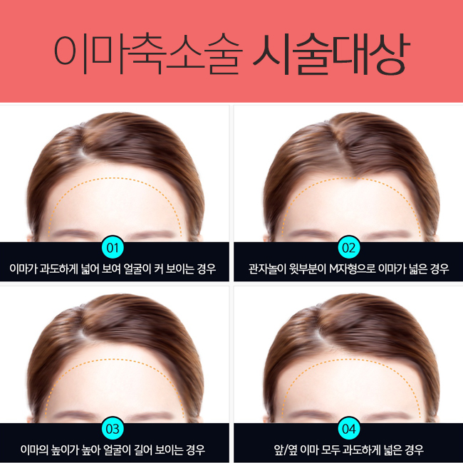 이마축소수술로 넓고 긴 이마를 작은얼굴로! 관련 이미지 3