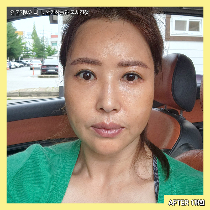 중년눈밑성형 아직도 고민하신다면 관련 이미지 4