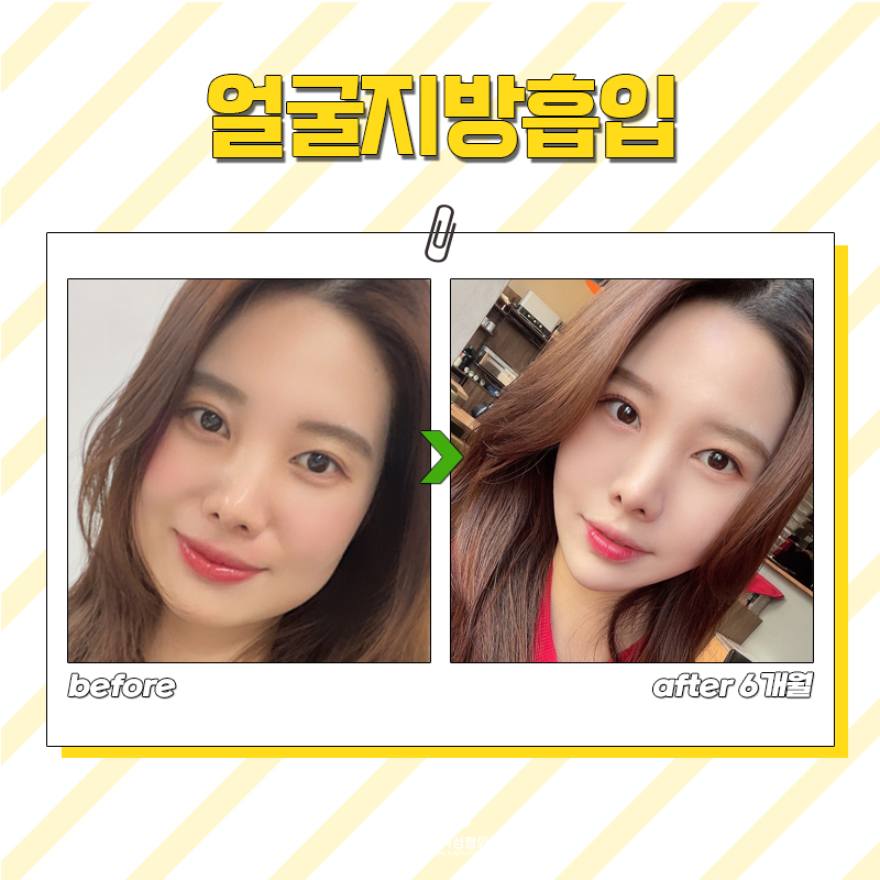 확실하게 얼굴지방없애는법 김형진베이직에서 알게 됐어요 관련 이미지 7