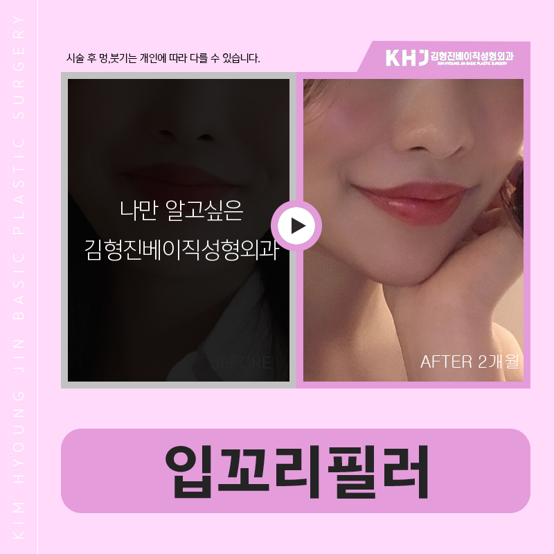 압구정입꼬리필러 하나로 인상이 완전히 달라졌어요ㅠㅠ 관련 이미지 7