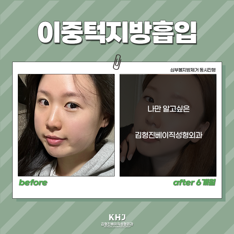 압구정이중턱지방흡입 어디가 좋을까 고민중이시라면? 관련 이미지 2