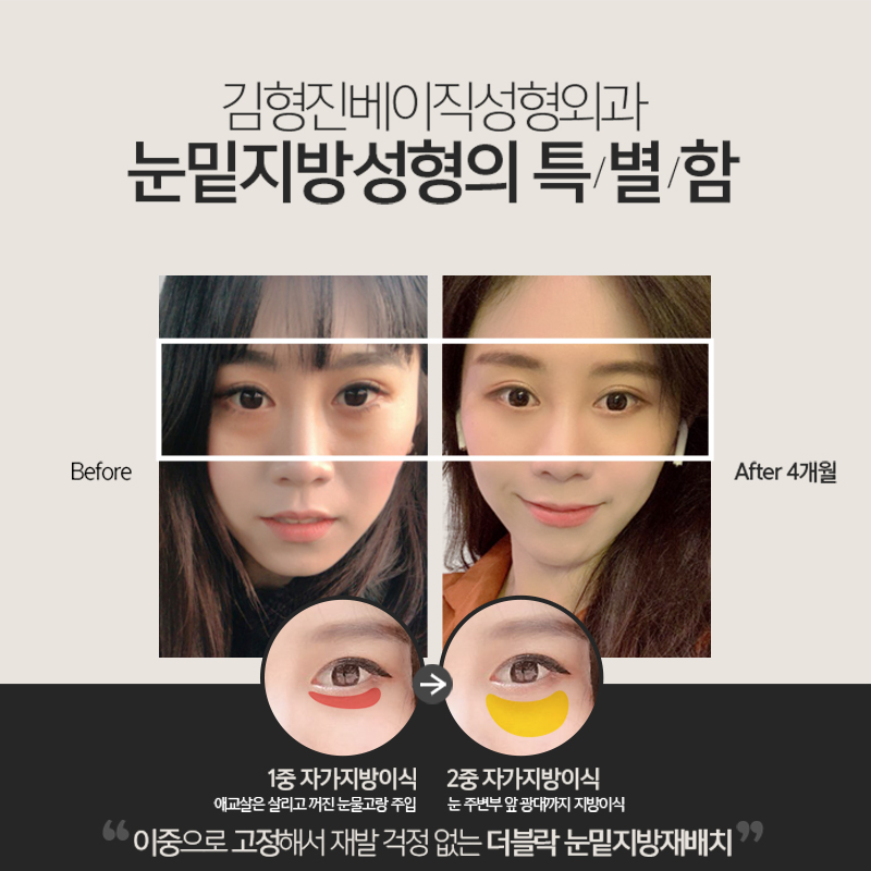 눈밑지방재배치후기 봐주실 분 관련 이미지 4