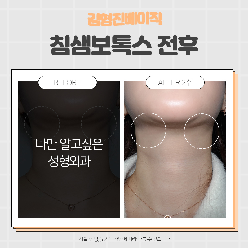자연스러움이 다른 침샘보톡스후기 후회 없어요 관련 이미지 6