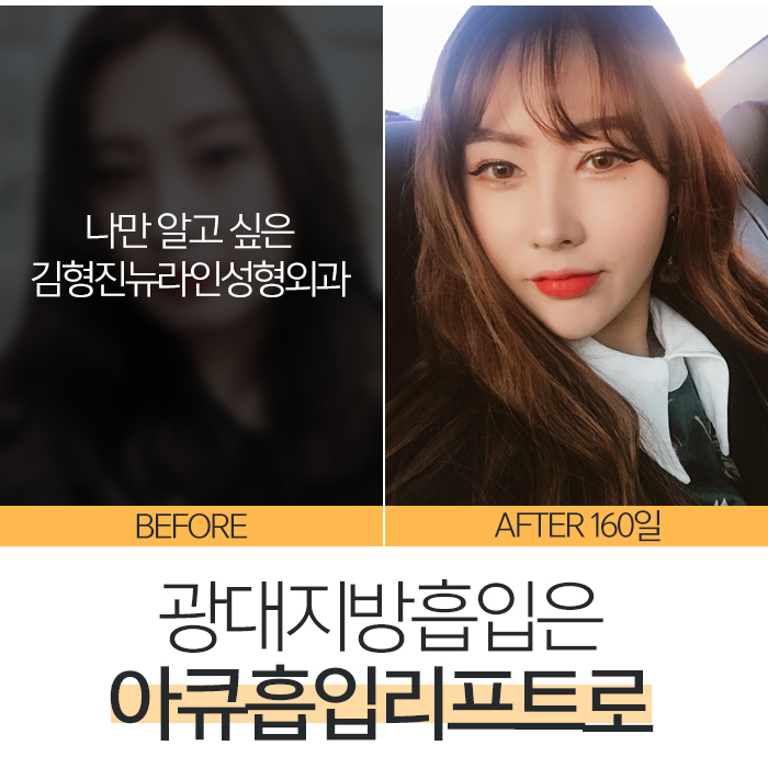 광대살지방흡입 이렇게 하는 거였어? 관련 이미지 2