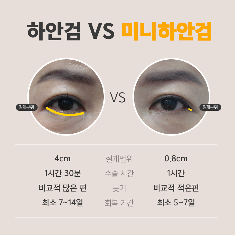 중년눈밑수술병원 안전하게 잘하는 곳 관련 이미지 4