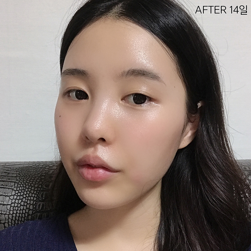심부볼제거술, 확실한 볼살제거 방법 관련 이미지 5