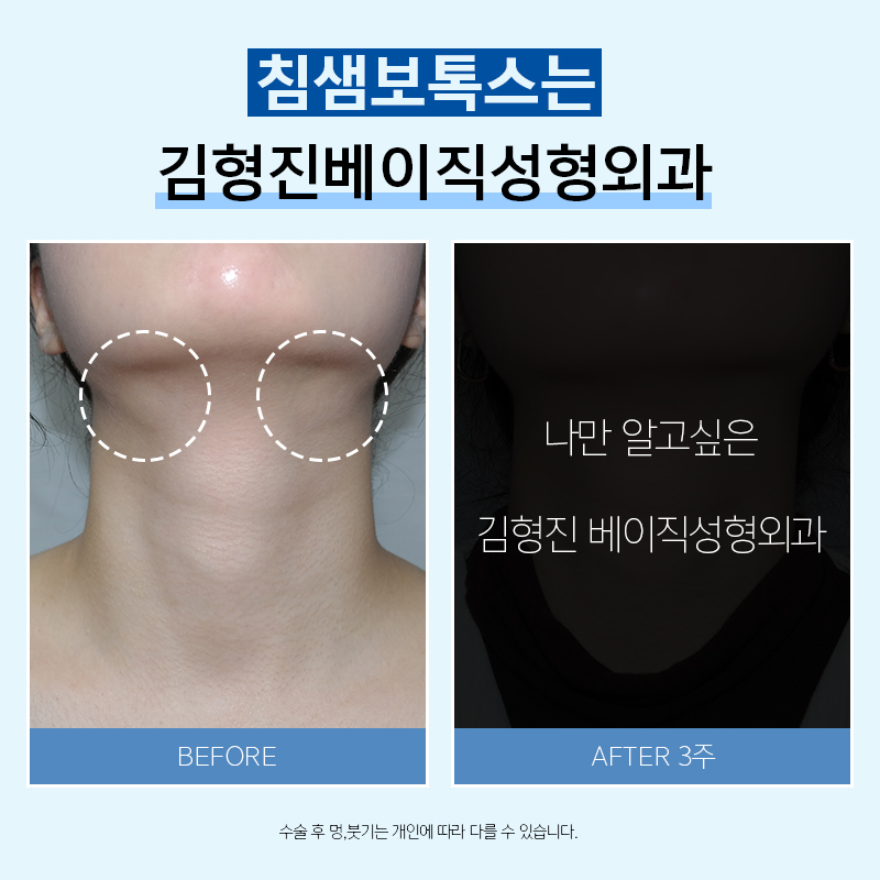 침샘비대증, 이거면 끝! 관련 이미지 3