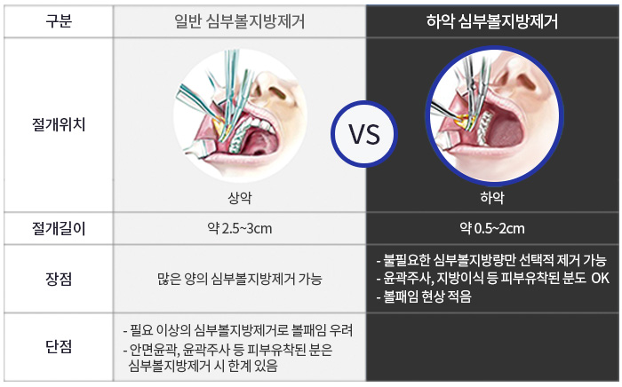 남자볼살없애기 실패한 이유, 아직 몰라요? 관련 이미지 6