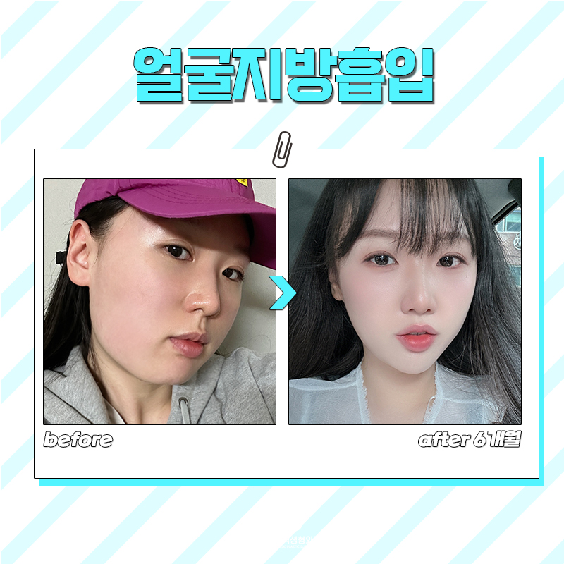 얼굴살 빼고싶다면 얼지흡후기 보고 결정하세요 관련 이미지 6