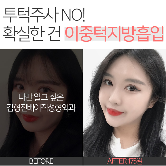 투턱주사 언제까지 맞으려구요? 관련 이미지 8