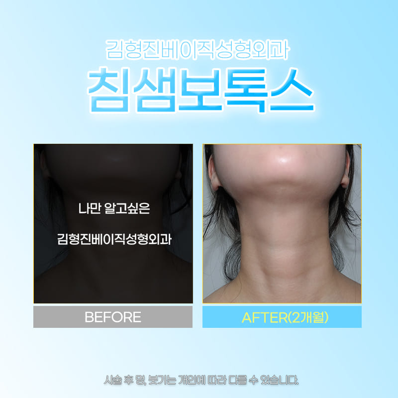 침샘비대증시술 아무 데서나 받으면 안되는 이유 관련 이미지 6