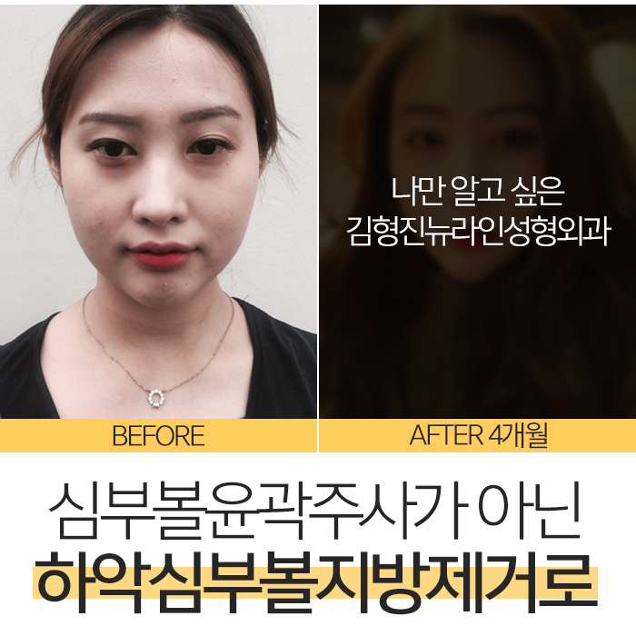 심부볼윤곽주사 누가 가능하대? 관련 이미지 2