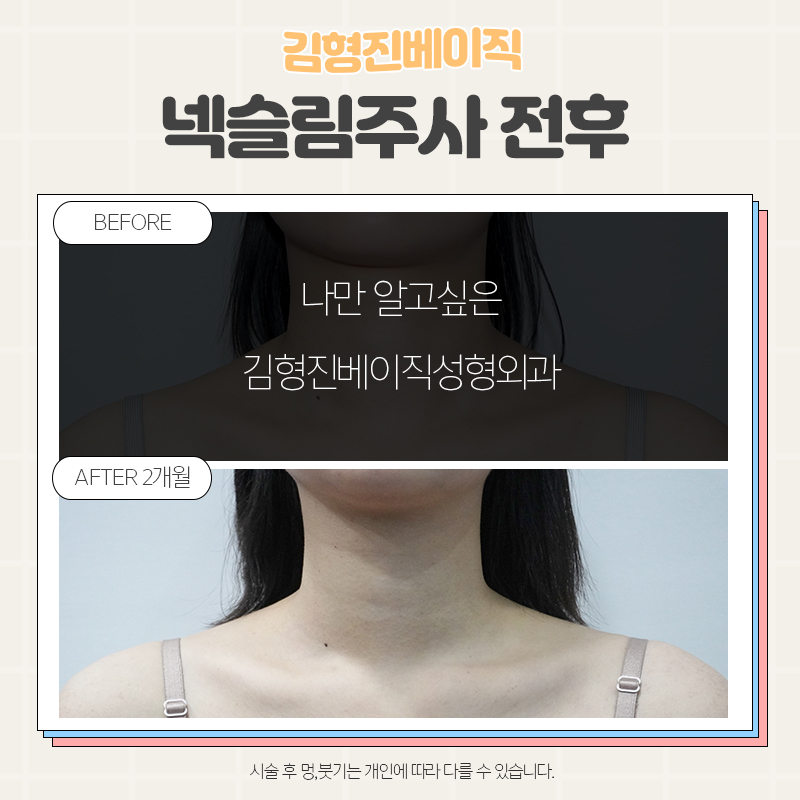 목보톡스전후 궁금하셨다면 여기로! 관련 이미지 3
