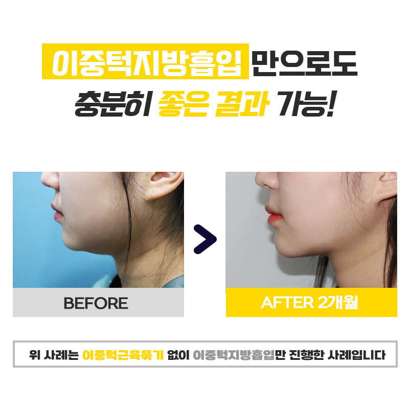 식단 없이 이중턱빼는방법? 무조건 가능합니다 관련 이미지 7