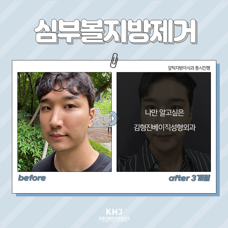 심부볼지방제거부작용 걱정하지 마세요! 관련 이미지 5