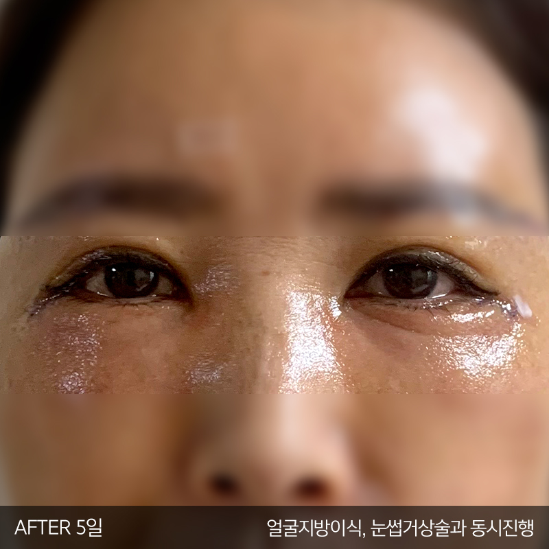 미니하안검수술은 김형진베이직이죠 관련 이미지 4