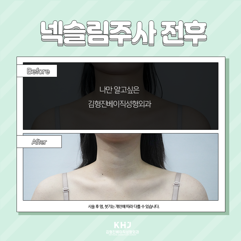 넥슬림주사효과 이렇게나 대단해! 관련 이미지 6