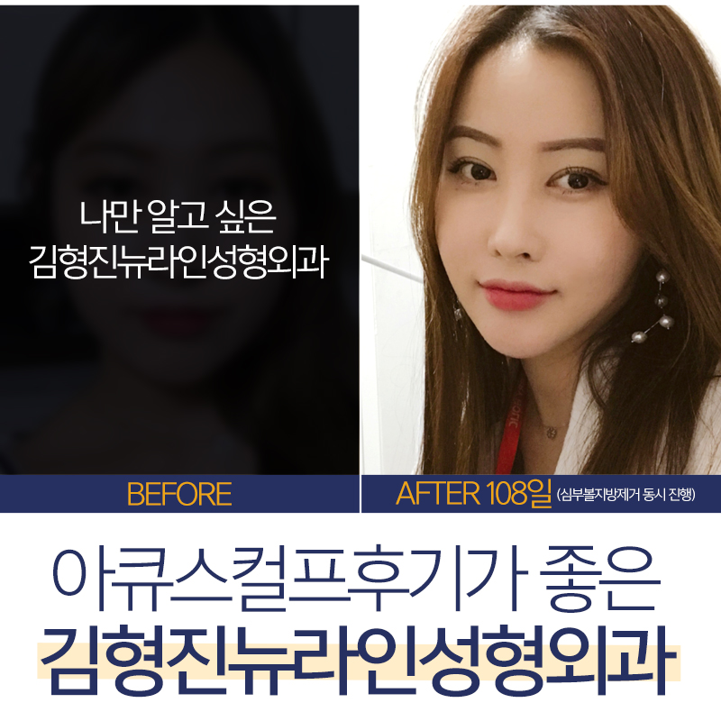 아큐스컬프후기 아주 좋아 관련 이미지 5